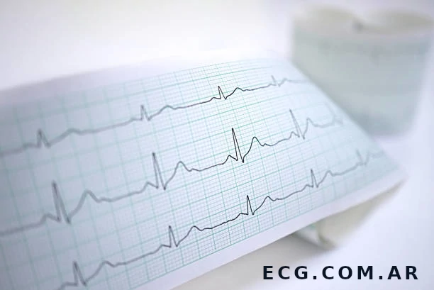 Electrocardiograma con Informe